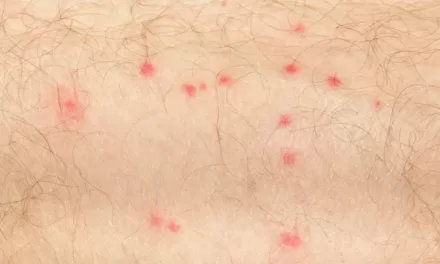 Spots and Mosquitos