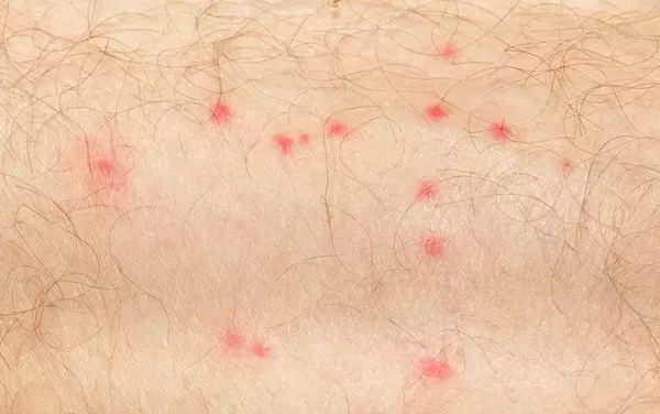 Spots and Mosquitos