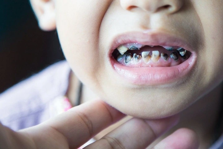 Lack of Fluoride Risks Poor Dental Health for Local Children